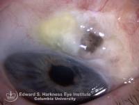 Iris prolapse into trabeculectomy fistula.
